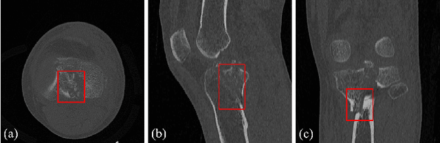 Figure 1 for Learning Generalizable Features for Tibial Plateau Fracture Segmentation Using Masked Autoencoder and Limited Annotations