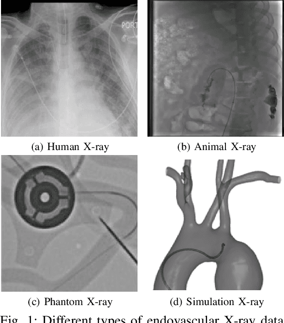 Figure 1 for FedEFM: Federated Endovascular Foundation Model with Unseen Data