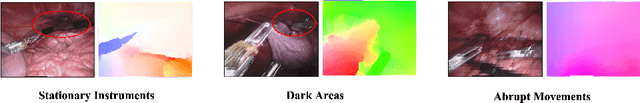 Figure 1 for Rethinking Low-quality Optical Flow in Unsupervised Surgical Instrument Segmentation