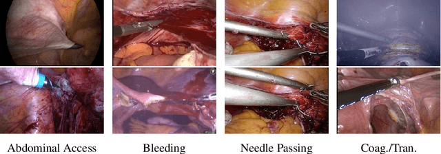 Figure 2 for Event Recognition in Laparoscopic Gynecology Videos with Hybrid Transformers