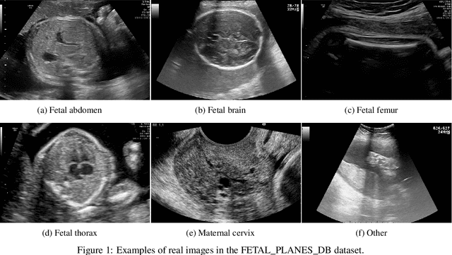 Figure 2 for Enhancing Fetal Plane Classification Accuracy with Data Augmentation Using Diffusion Models