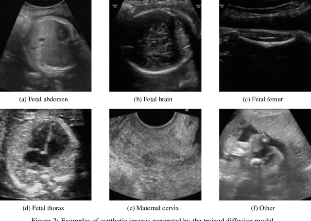 Figure 4 for Enhancing Fetal Plane Classification Accuracy with Data Augmentation Using Diffusion Models