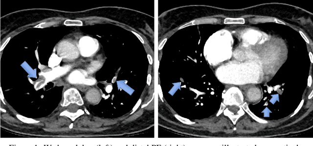 Figure 1 for Mortality Prediction of Pulmonary Embolism Patients with Deep Learning and XGBoost