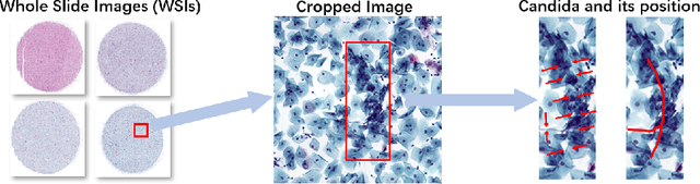 Figure 1 for Progressive Attention Guidance for Whole Slide Vulvovaginal Candidiasis Screening
