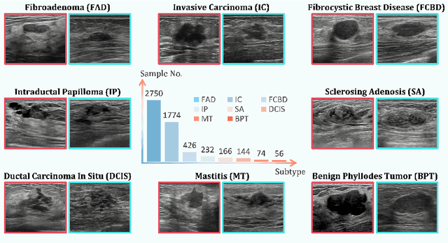 Figure 1 for Subtyping Breast Lesions via Generative Augmentation based Long-tailed Recognition in Ultrasound