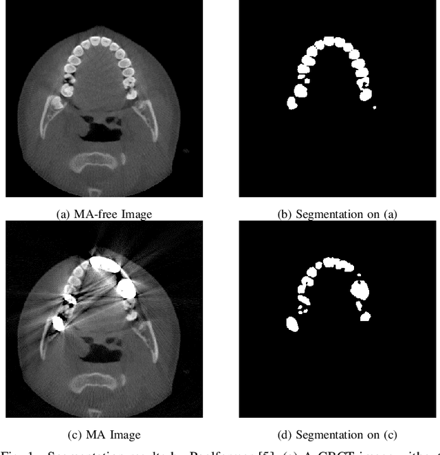 Figure 1 for MARformer: An Efficient Metal Artifact Reduction Transformer for Dental CBCT Images