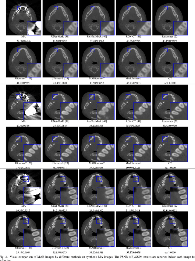 Figure 3 for MARformer: An Efficient Metal Artifact Reduction Transformer for Dental CBCT Images