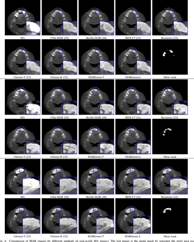 Figure 4 for MARformer: An Efficient Metal Artifact Reduction Transformer for Dental CBCT Images