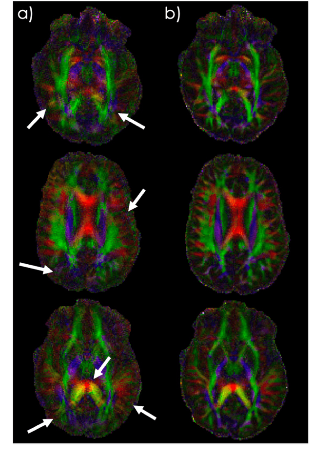 Figure 4 for ACE-Net: AutofoCus-Enhanced Convolutional Network for Field Imperfection Estimation with application to high b-value spiral Diffusion MRI