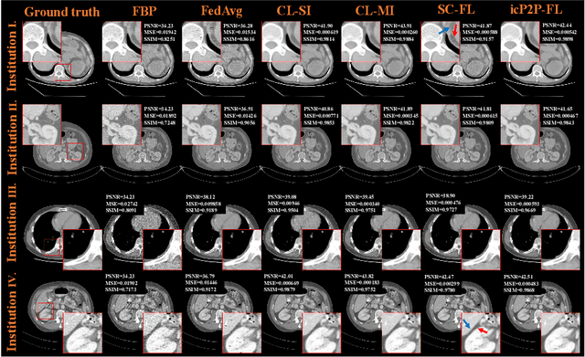 Figure 3 for A Peer-to-peer Federated Continual Learning Network for Improving CT Imaging from Multiple Institutions