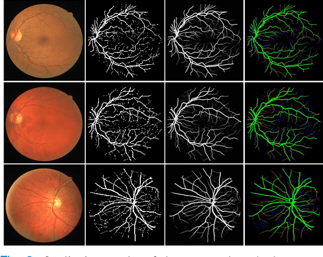 Figure 2 for Region Guided Attention Network for Retinal Vessel Segmentation