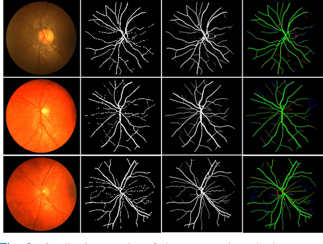 Figure 3 for Region Guided Attention Network for Retinal Vessel Segmentation