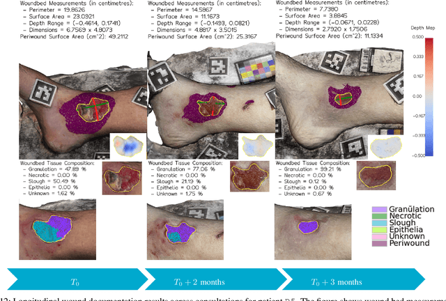 Figure 4 for Wound3DAssist: A Practical Framework for 3D Wound Assessment
