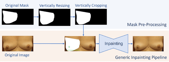 Figure 3 for An inpainting approach to manipulate asymmetry in pre-operative breast images