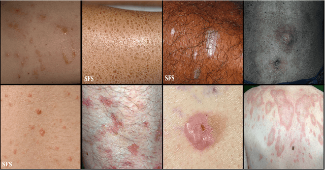 Figure 3 for Biasing & Debiasing based Approach Towards Fair Knowledge Transfer for Equitable Skin Analysis