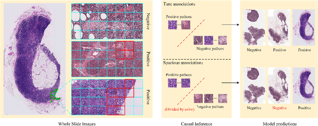Figure 1 for Establishing Truly Causal Relationship Between Whole Slide Image Predictions and Diagnostic Evidence Subregions in Deep Learning