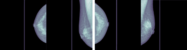 Figure 1 for Deep Learning for Breast Cancer Detection: Comparative Analysis of ConvNeXT and EfficientNet