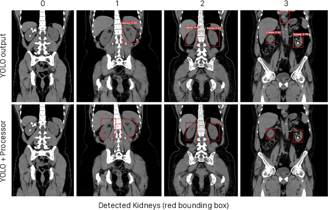 Figure 4 for Lightweight Framework for Automated Kidney Stone Detection using coronal CT images