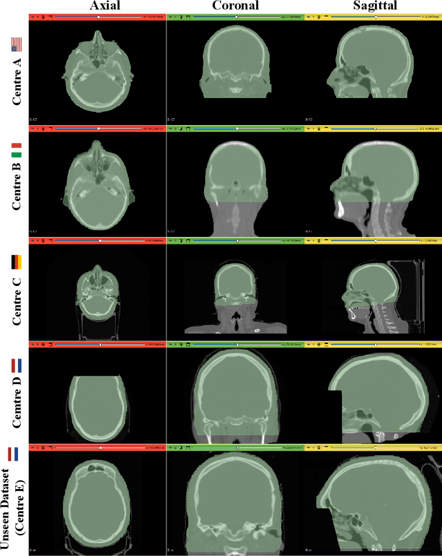 Figure 3 for FedSynthCT-Brain: A Federated Learning Framework for Multi-Institutional Brain MRI-to-CT Synthesis