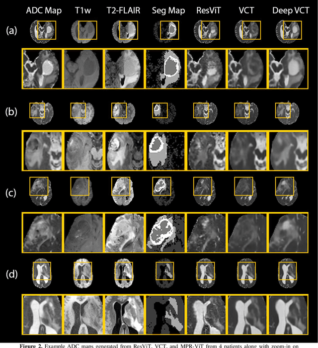 Figure 3 for Deep Learning Based Apparent Diffusion Coefficient Map Generation1 from Multi-parametric MR Images for Patients with Diffuse Gliomas