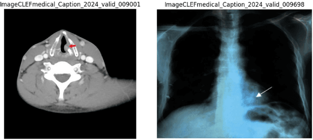 Figure 4 for DS@BioMed at ImageCLEFmedical Caption 2024: Enhanced Attention Mechanisms in Medical Caption Generation through Concept Detection Integration