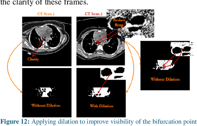 Figure 4 for Methods to Measure the Broncho-Arterial Ratio and Wall Thickness in the Right Lower Lobe for Defining Radiographic Reversibility of Bronchiectasis