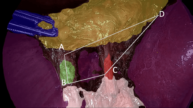 Figure 4 for Automated Assessment of Critical View of Safety in Laparoscopic Cholecystectomy