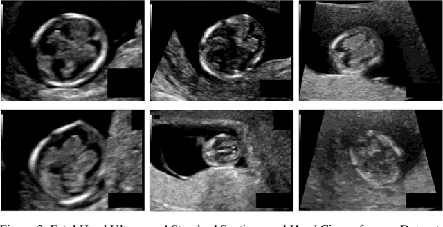 Figure 4 for Uncertainty Modeling in Ultrasound Image Segmentation for Precise Fetal Biometric Measurements