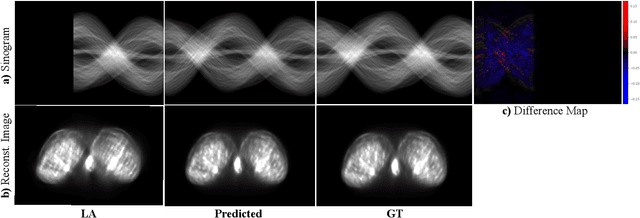 Figure 1 for Diffusion-based Sinogram Interpolation for Limited Angle PET