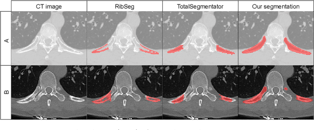 Figure 3 for Automated Thoracolumbar Stump Rib Detection and Analysis in a Large CT Cohort