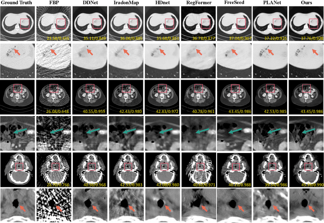 Figure 4 for Learning Task-Specific Sampling Strategy for Sparse-View CT Reconstruction