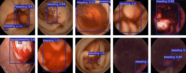 Figure 3 for Transformer-Based Wireless Capsule Endoscopy Bleeding Tissue Detection and Classification