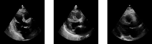 Figure 1 for CardioCaps: Attention-based Capsule Network for Class-Imbalanced Echocardiogram Classification