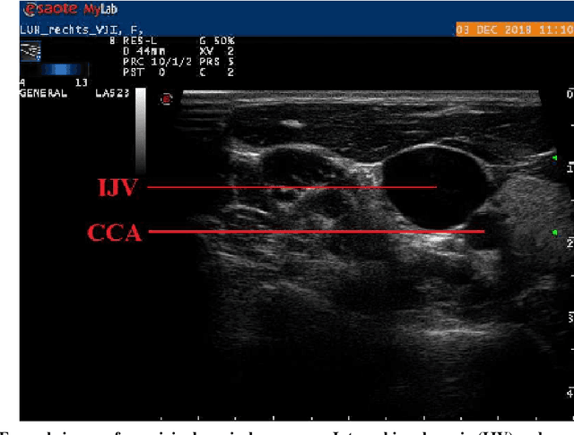 Figure 1 for Impact of PCA-based preprocessing and different CNN structures on deformable registration of sonograms