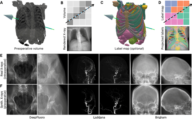 Figure 2 for Rapid patient-specific neural networks for intraoperative X-ray to volume registration