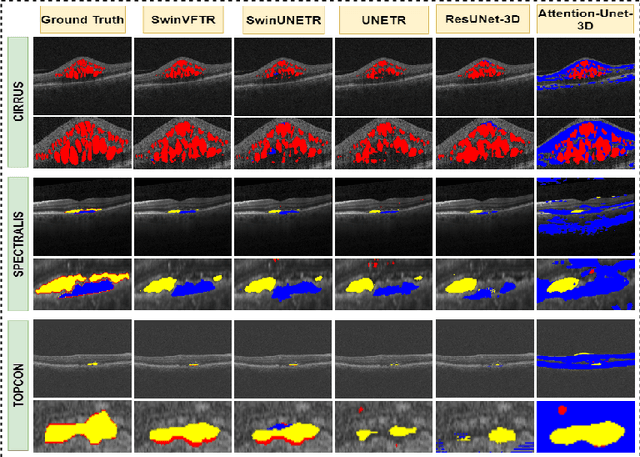 Figure 3 for SwinVFTR: A Novel Volumetric Feature-learning Transformer for 3D OCT Fluid Segmentation