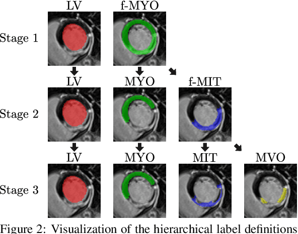 Figure 3 for CaRe-CNN: Cascading Refinement CNN for Myocardial Infarct Segmentation with Microvascular Obstructions