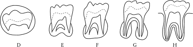 Figure 1 for Attention Maps in 3D Shape Classification for Dental Stage Estimation with Class Node Graph Attention Networks