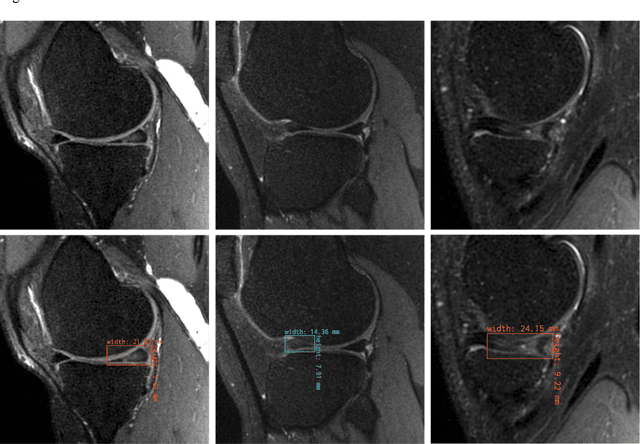 Figure 2 for The object detection method aids in image reconstruction evaluation and clinical interpretation of meniscal abnormalities