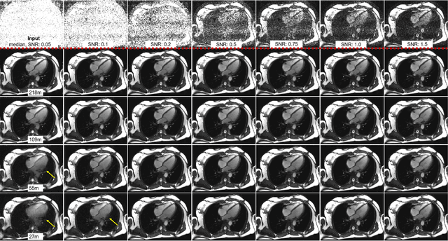Figure 3 for Imaging Transformer for MRI Denoising: a Scalable Model Architecture that enables SNR << 1 Imaging