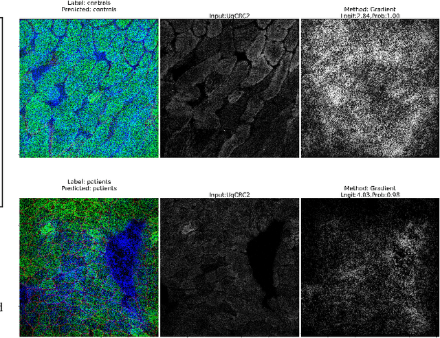 Figure 4 for Explainable Deep Learning to Profile Mitochondrial Disease Using High Dimensional Protein Expression Data