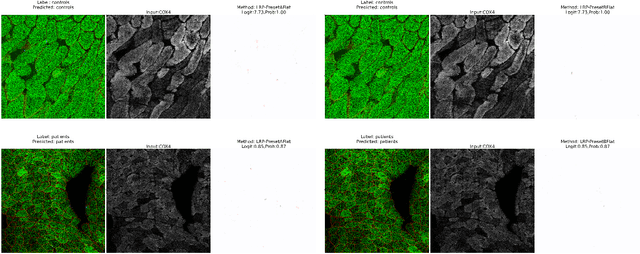 Figure 2 for Explainable Deep Learning to Profile Mitochondrial Disease Using High Dimensional Protein Expression Data