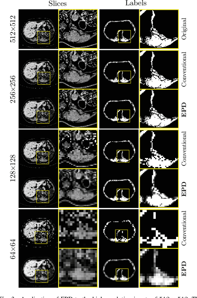 Figure 3 for Towards Efficient and Accurate CT Segmentation via Edge-Preserving Probabilistic Downsampling
