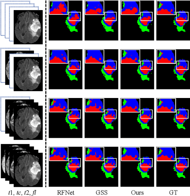 Figure 3 for Decoupling Feature Representations of Ego and Other Modalities for Incomplete Multi-modal Brain Tumor Segmentation