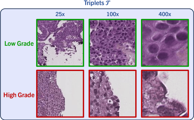 Figure 3 for NMGrad: Advancing Histopathological Bladder Cancer Grading with Weakly Supervised Deep Learning