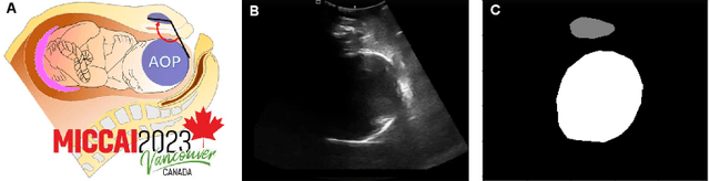 Figure 1 for Pubic Symphysis-Fetal Head Segmentation Network Using BiFormer Attention Mechanism and Multipath Dilated Convolution