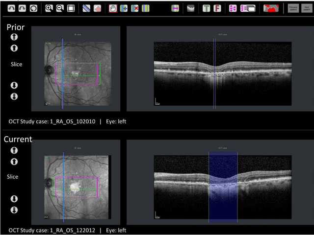 Figure 1 for Simultaneous column-based deep learning progression analysis of atrophy associated with AMD in longitudinal OCT studies
