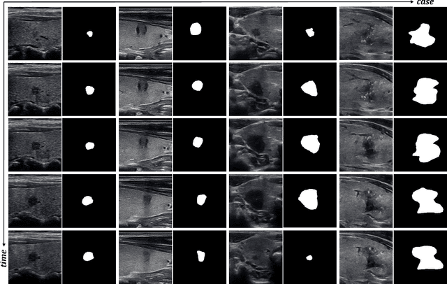 Figure 1 for Vivim: a Video Vision Mamba for Medical Video Object Segmentation