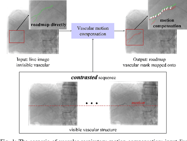 Figure 1 for Optical flow-based vascular respiratory motion compensation