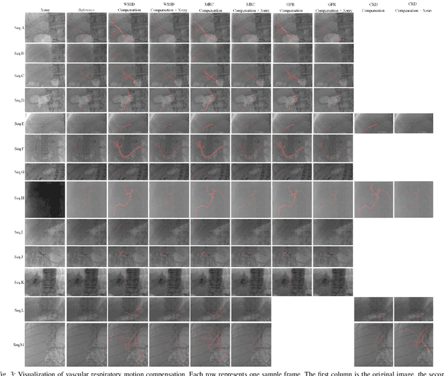 Figure 3 for Optical flow-based vascular respiratory motion compensation
